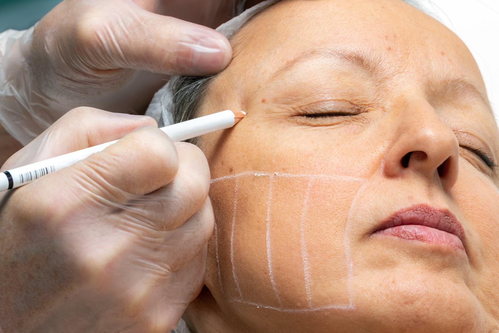 Hands painting facial guidelines for hifu energy treatment on female face.